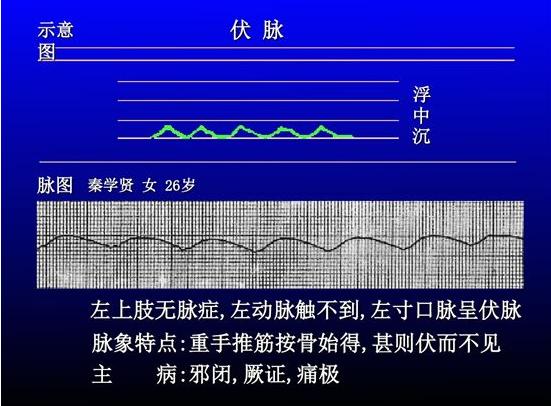 "许多医家拘泥于此,认为动脉仅见于关部,而《脉诀汇辨》认为寸关尺三