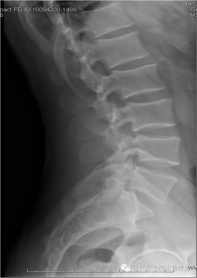 10分钟自学腰椎病x线诊断