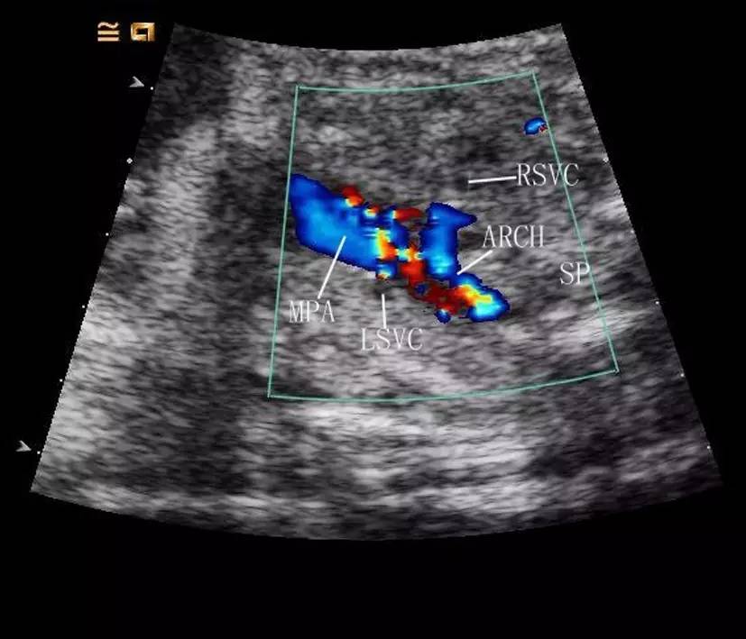 主動脈弓縮窄與主動脈弓離斷的產前超聲診斷