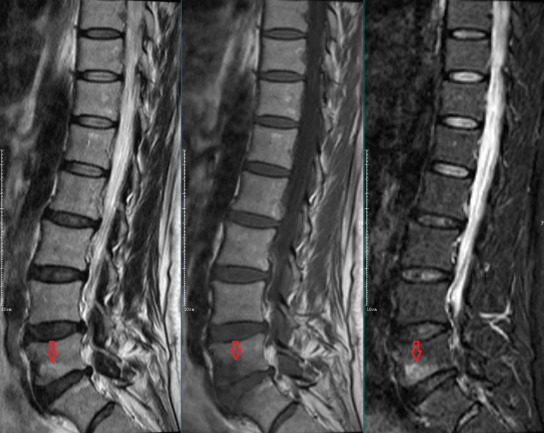 椎体终板炎发生机制分型以及mri表现