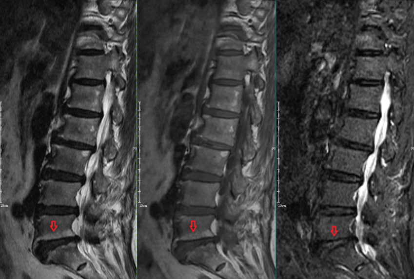 椎体终板炎发生机制分型以及mri表现