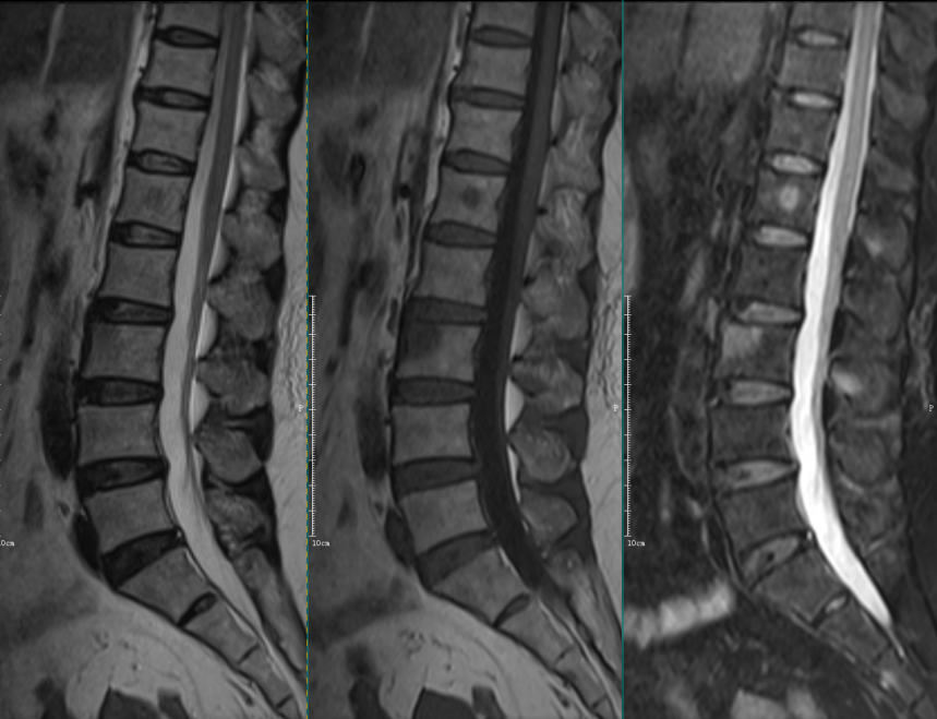 椎体终板炎发生机制分型以及mri表现