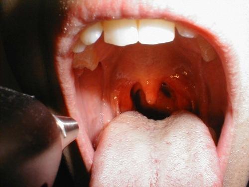 咽腭弓滤泡图片