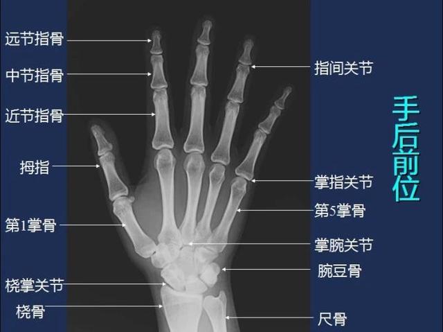 手掌骨x线解剖图图片