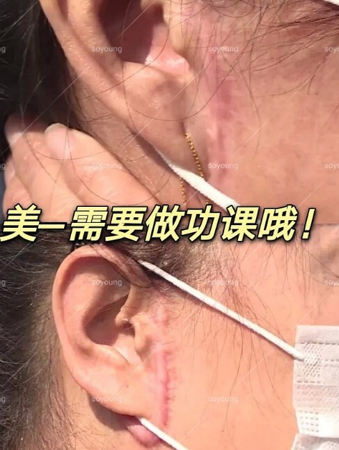 大拉皮手术有危险吗手术拉皮耳边疤痕图片后遗症