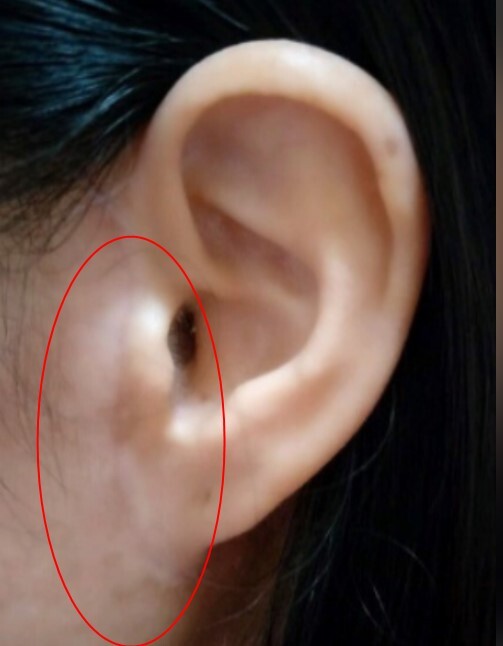 拉皮后的疤痕增生怎么办手术拉皮耳边疤痕图片