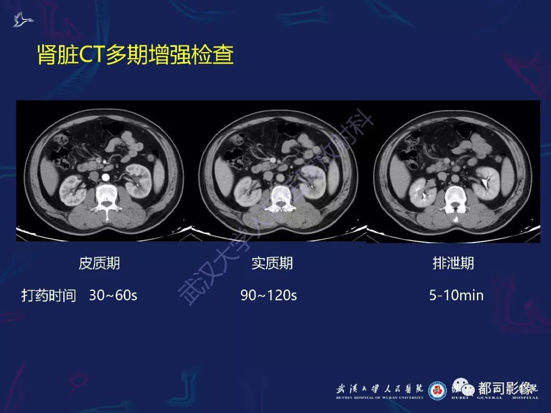 常見腎臟腫瘤影像診斷