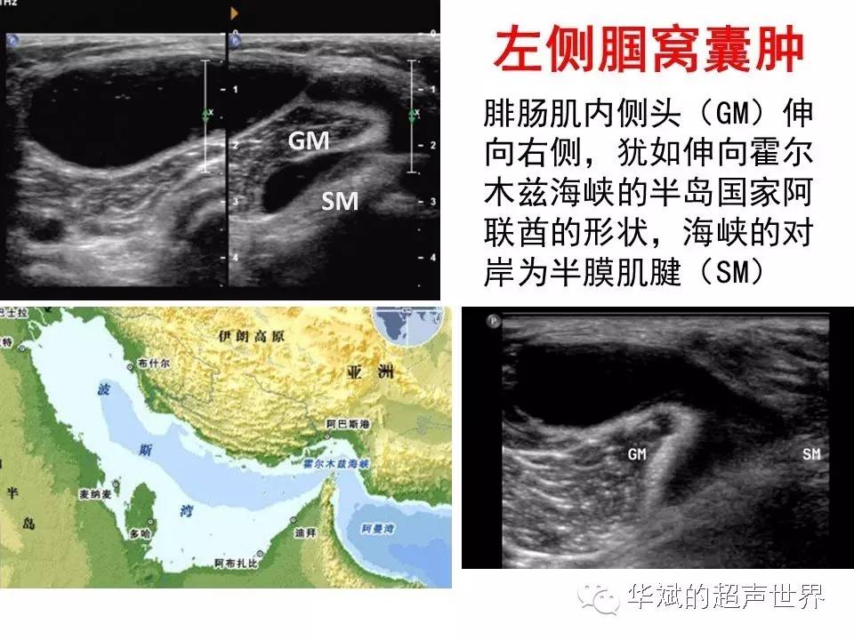 霍尔木兹海峡及墨西哥湾与超声及腘窝囊肿的关系