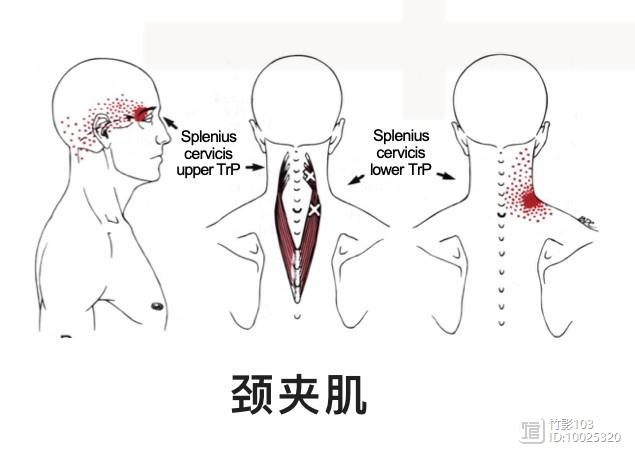 颈夹肌激痛点图片