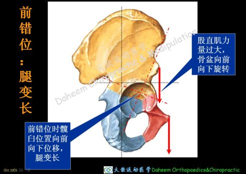 轉骶髂關節錯位長短腿的深度分析與手法治療欒氏原編