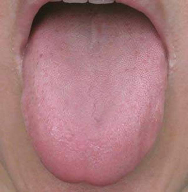 正常舌头的照片图片