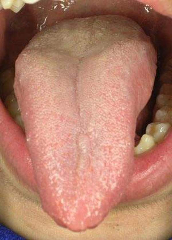 梅毒舌头早期症状图片图片
