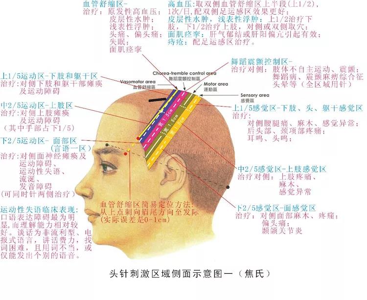 焦氏头针定位图解图片