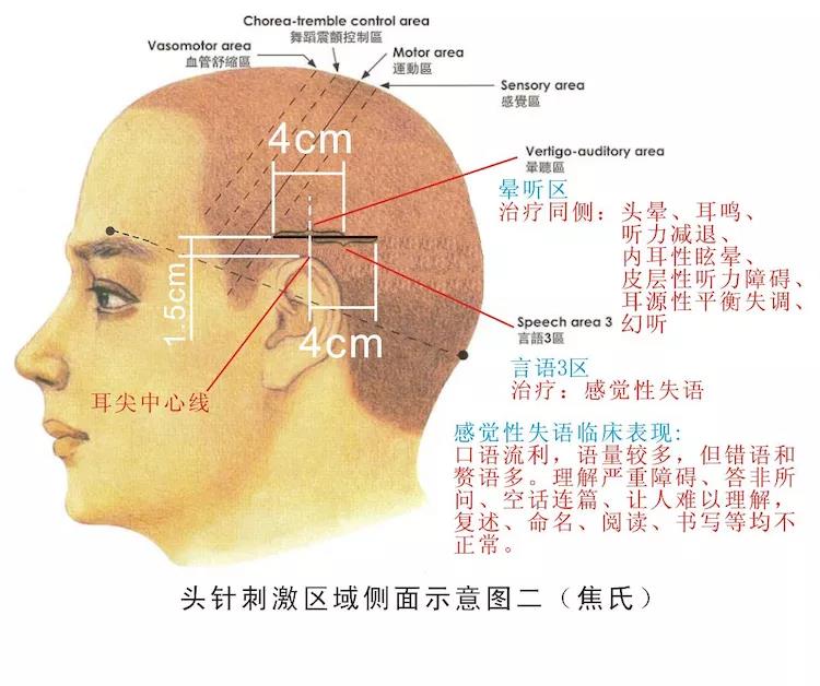 头针语言区图解图片