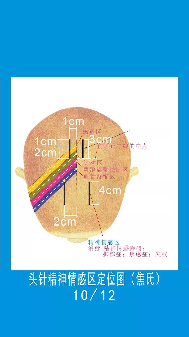 焦氏头皮针图片