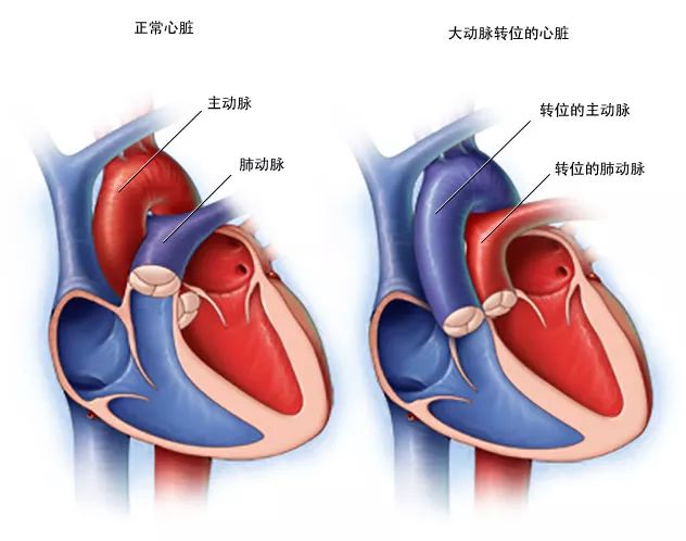 虽然形成了主肺动脉隔,也完成了旋转,但是主肺动脉隔对原始动脉干起始