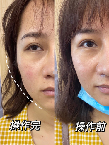 7d聚拉提有效果吗7d聚拉提效果维持多久