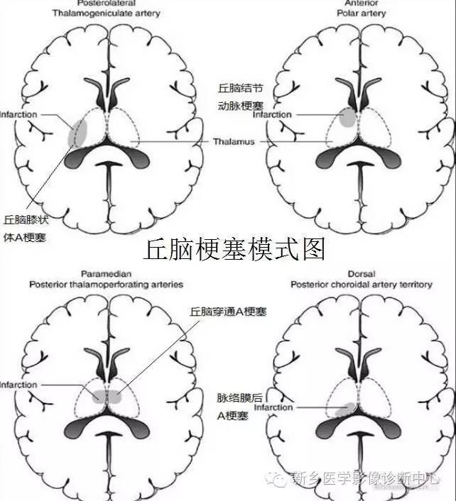 丘腦外側核是各種感覺總彙, 主要表現為一過性對側輕偏癱,持續性的對