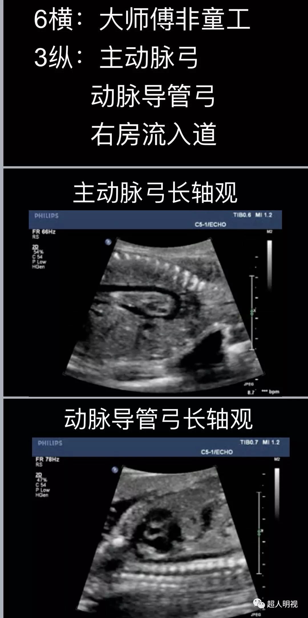 3,三個縱切面,主動脈弓,動脈導管弓,上下腔2,從下到上,六個橫切面極其