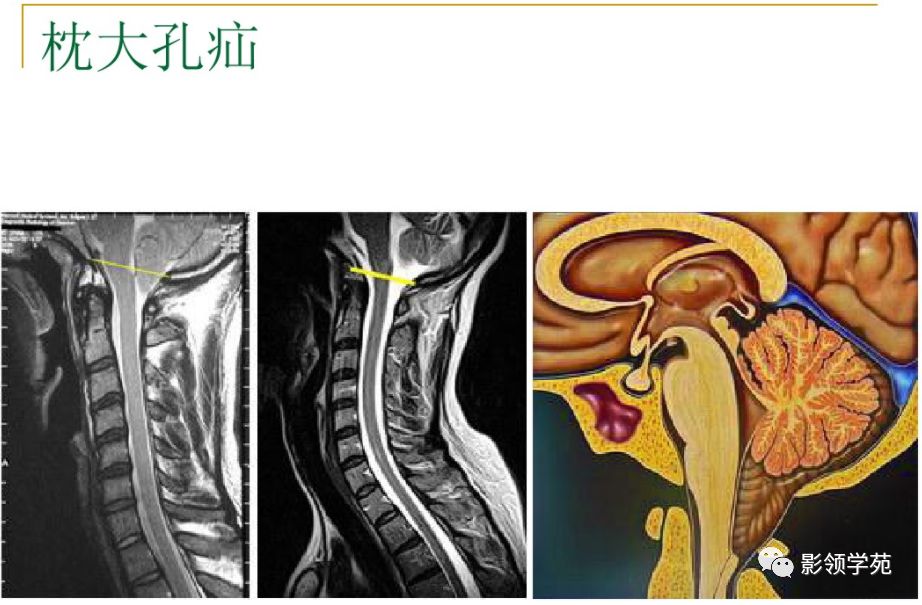 脑疝分类及影像学表现图解