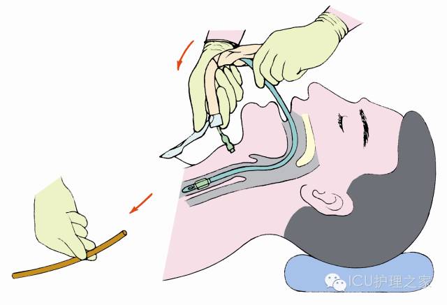 气管插管操作流程及评分标准