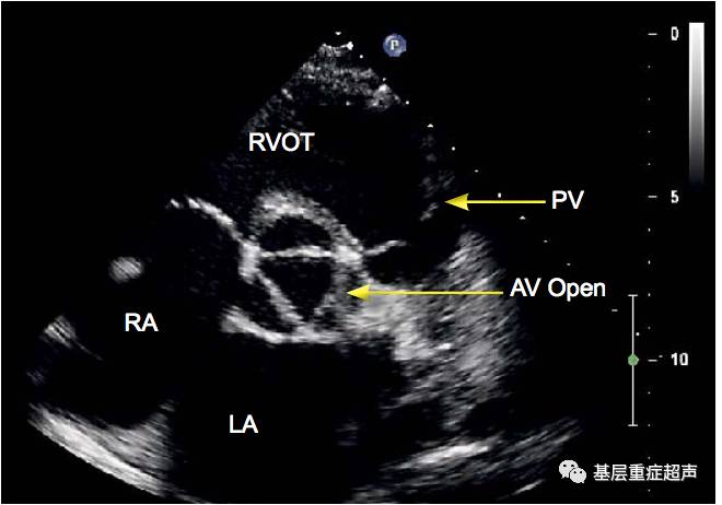 奔驰征胸骨旁短轴切面/主动脉瓣与右心室流出道胸骨旁短轴切面/二尖瓣