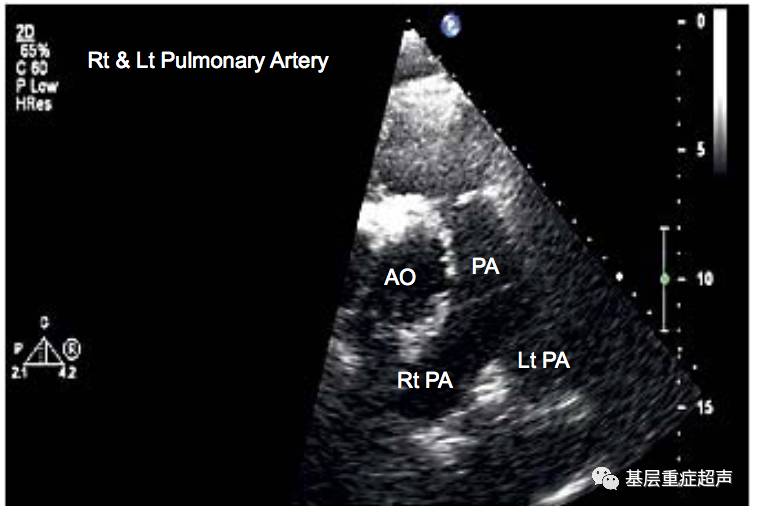 rvot,右心室流出道;pv,肺動脈瓣;av open,主動脈瓣開放;ra,右心房;la