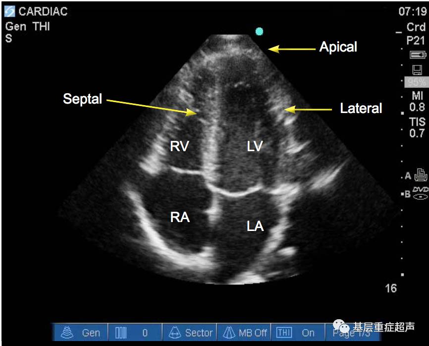 超声心动图切面介绍胸骨旁长轴胸骨旁短轴心尖切面剑突下切面