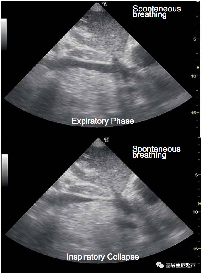 超声心动图切面介绍胸骨旁长轴胸骨旁短轴心尖切面剑突下切面