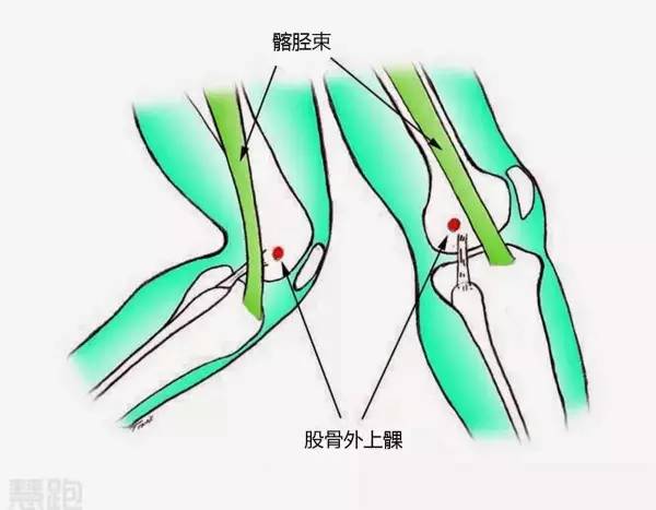 髂脛束是一條平行於股骨,連接臀部和膝蓋的結締組織.