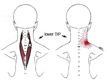 八,肱三頭肌(triceps brachii)1,肌肉位置:2,激痛點位置和關聯痛區域