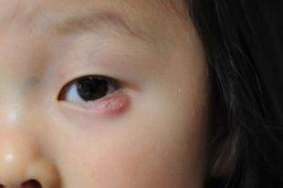 小眼症是什么症状图片