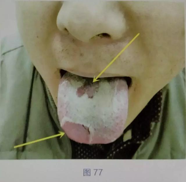 舌苔中间缺一块图片图片